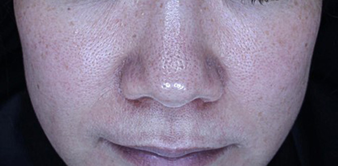 症例写真4アフター