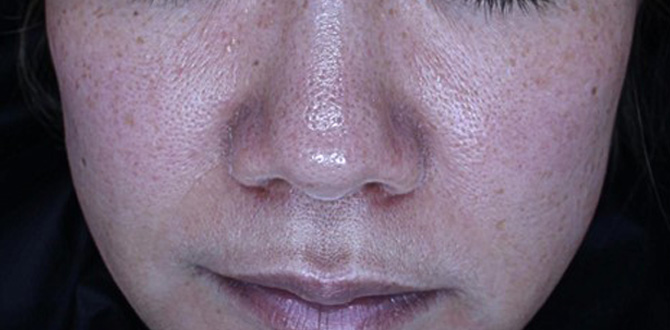 症例写真4ビフォー