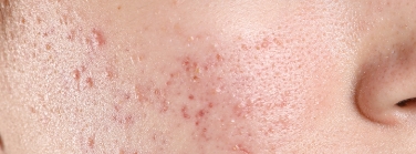 炎症後色素沈着